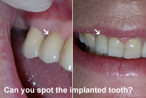Can you spot the implanted tooth?